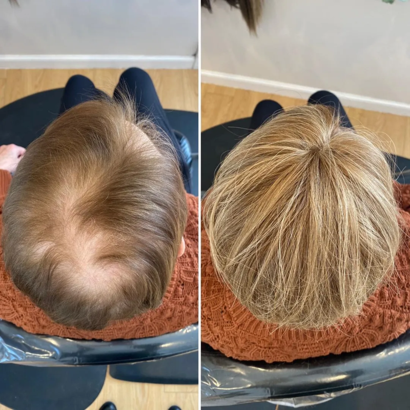 CrownLift™️ Capelli corti fini per le donne