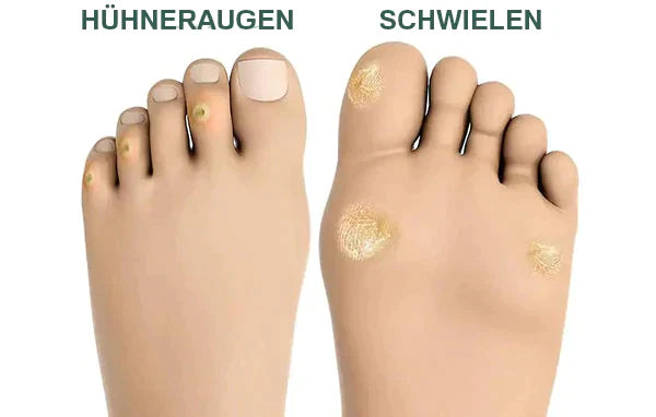 FootPro™️ Gel per la rimozione dei calli