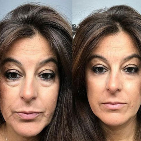 VerfonsEyes™️ Crema ai peptidi per occhi e rughe