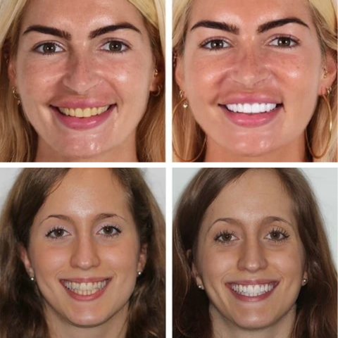 Vital Smile™ Super Probiotic-6 dentifricio con 6 probiotici