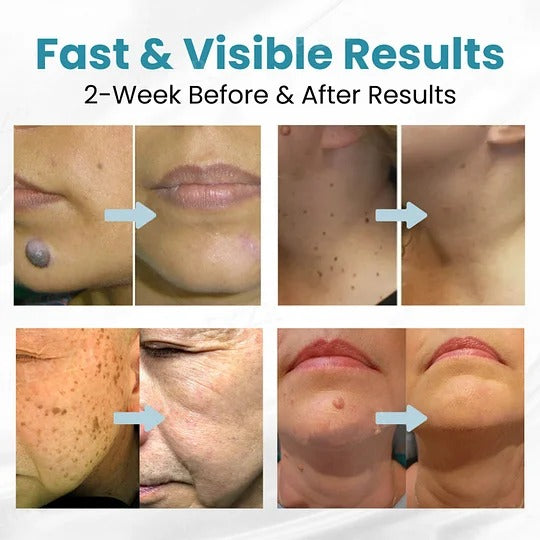 HOOMWELL™ Penna laser non invasiva  per la rimozione di voglie e verruche